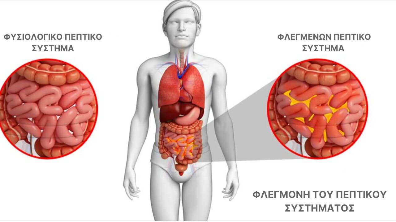 Περιτονίτιδα Αιτίες, Συμπτώματα και Θεραπεία