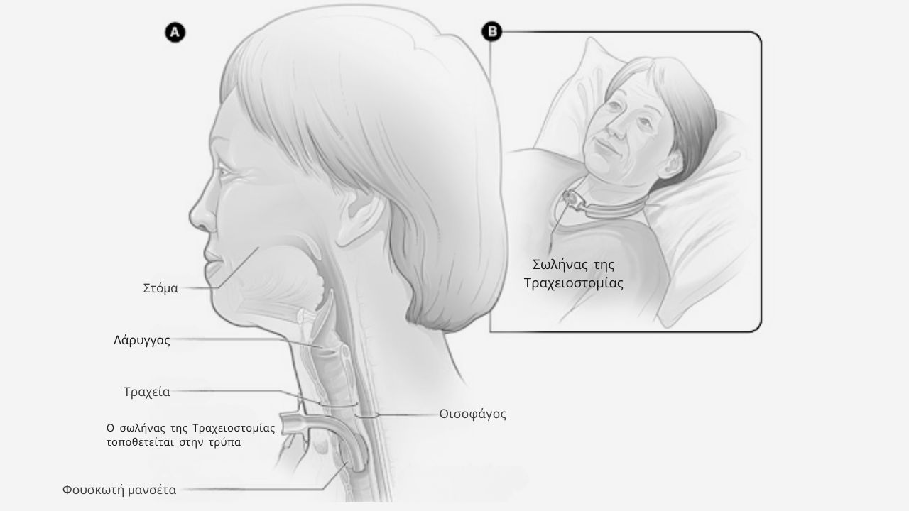 Τι είναι η Τραχειοστομία ποια ειναι η διαδικασία και συμβουλές φροντίδας